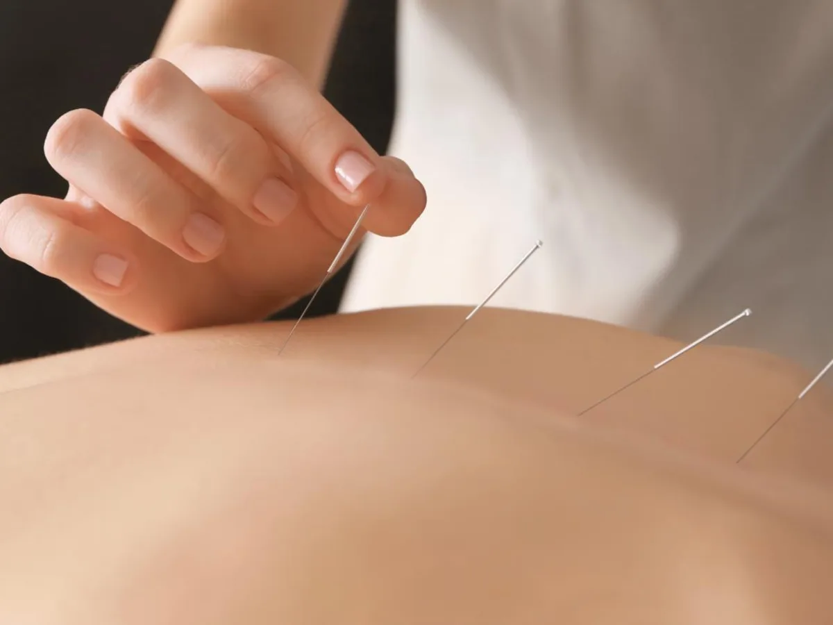 Pose d'aiguilles d'acupuncture stériles à usage unique dans le dos d'une patiente allongée